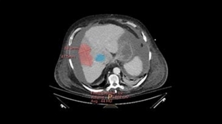 Philips IntelliSpace Portal for CT Oncology